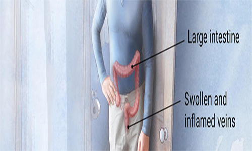 What causes hemorrhoids?
